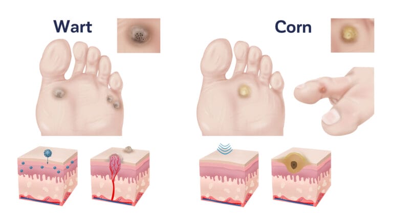 Verruca vs Corn: Key Differences in Causes, Symptoms, and Treatment